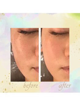 ミュー(professional beauty salon MYU)/リアボーテハーブで肌質改善