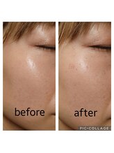 エムスラッシュアヴェダ 自由が丘(M.SLASH AVEDA)/シミケア！美肌を目指す！