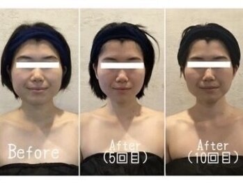 小顔フェイスラボ 伊勢店(小顔FaceLabo.)/◆小顔コルギ Before→After◆