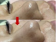 ブリリアン デイスパ 阪急西宮ガーデンズ店(BRILLIAN DAYSPA)/毛穴洗浄フェイシャル