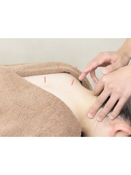 鍼灸施術を受けたい