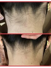 ミレボ(Me.rebo)/うなじ脱毛before→after
