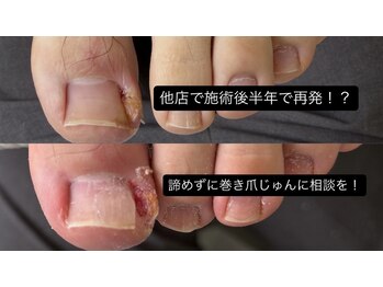 巻き爪じゅん 千葉駅前店/再発した巻き爪も改善できます！