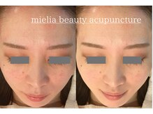 ミエリア美容鍼灸院(mielia美容鍼灸院)/幹細胞美容鍼灸〈幹細胞facia〉