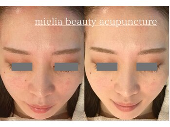ミエリア美容鍼灸院(mielia美容鍼灸院)/幹細胞美容鍼灸〈幹細胞facia〉