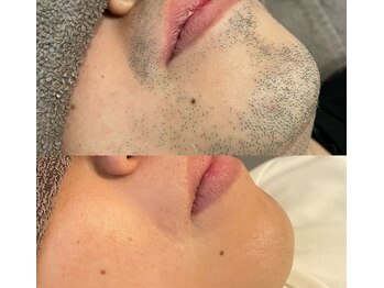エクラ(eclat)の写真/【口コミ高評価】脱毛歴8年!効果実感の早さで選ばれるメンズ脱毛◎他店様からの乗り換えが多いリアル実力派