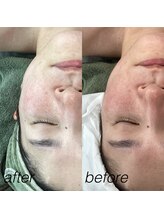 トリップ(trip)/BBL フェイシャルトリートメント