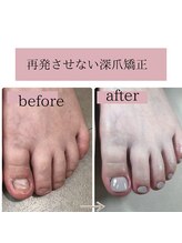 ティアラネイル(tiaranail)/再発させない深爪矯正
