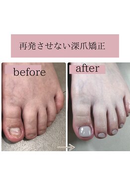 ティアラネイル(tiaranail)/再発させない深爪矯正