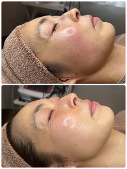 サロン ハリー(SALON HARRY)/韓国肌管理ララピールLHALA