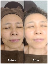 ミル(milu)/選べるセレクト美容液／ヒトカン