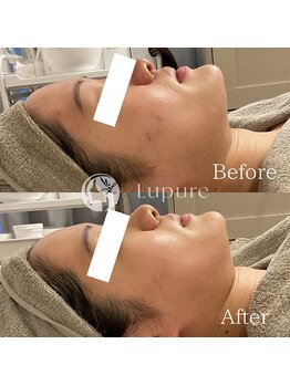 ルプレ(Lupure)/ハーブピーリング5回目
