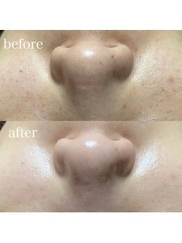 薫風/毛穴洗浄/20代