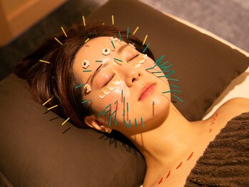 アルセア(ALCEA)/たるむ・むくみスッキリ！美極鍼