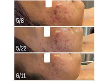 ミュウ(Myu)/フェイシャル