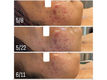 ミュウ(Myu)/フェイシャル