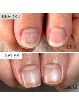 丸爪でお悩みの方