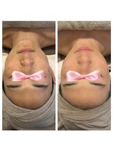 美温(mion)/インディバF×マーメイドセル