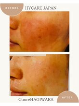 クオーレ ハギワラ(cuore HAGIWARA)/肌質改善/赤み・敏感