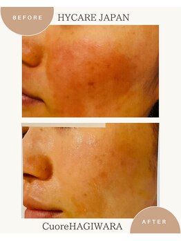 クオーレ ハギワラ(cuore HAGIWARA)/肌質改善/赤み・敏感