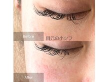 ティセ(TisseR)の雰囲気（目の小シワ・トーンアップ即効性のあるハーブピーリングで艶肌）