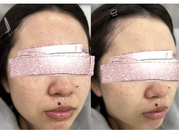 モガナ(mogana)/フェイスクリーニング１回