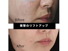 女性人気No1★小顔リフトアップメニュー