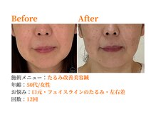 シルエラバレ(CiruelaValle)/Before After