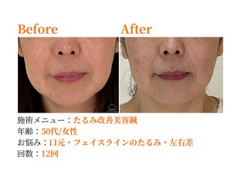 シルエラバレ(CiruelaValle)/Before After