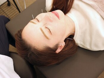 三国駅前ビューティー鍼灸院(三国駅前Beauty鍼灸院)/美容鍼で小顔に