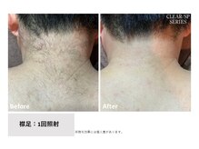 フィルムス(FILMS.)/襟足脱毛のBeforeAfter