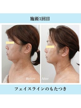 ノト(NOTO)/たるみ