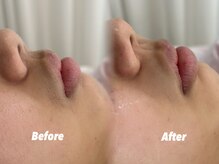 クイーン 渋谷店(QUEEN)/シェービングで肌質改善