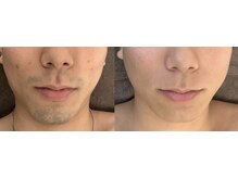 エルチェーロ(El Chulo)/ヒゲ脱毛