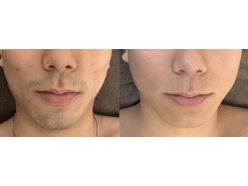 エルチェーロ(El Chulo)/ヒゲ脱毛