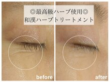 ラミーユ(La Miu)の雰囲気(目の下のしわがピン!と改善♪印象がかなり変わりますね♪)