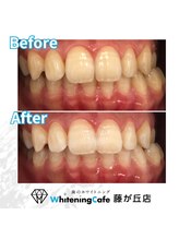 ホワイトニングカフェ 藤が丘店(WhiteningCafe)/ホワイトニングビフォーアフター