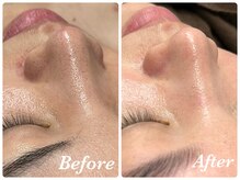 ミランオオサカ(MIRAN OSAKA)/お鼻の黒ずみ気になりませんか？