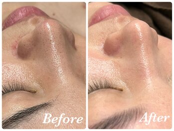 ミランオオサカ(MIRAN OSAKA)/お鼻の黒ずみ気になりませんか？