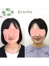 木の葉/20代/むくみ,輪郭,エラ張り改善