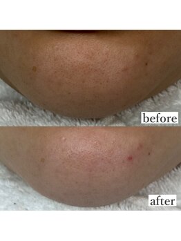 ライカブルー(RaicA BluE)/施術写真　before-after