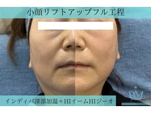 リメイククリニカルビューティー(Remake clinical beauty)/リフトアップ！