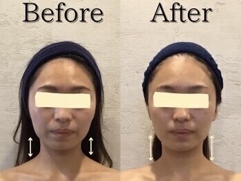 小顔フェイスラボ 伊勢店(小顔FaceLabo.)/◆小顔コルギ Before→After◆