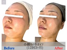 マリス(MARISS)/小顔コンテスト優秀賞受賞★