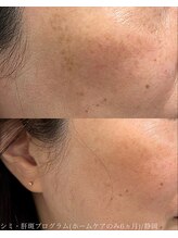 アウラプラス(Aura+)/塗るシミケア/6ヵ月