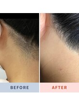 ランプシー(Lampsi)/気になるうしろ姿は脱毛で解決