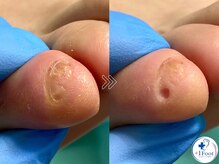 プラスワンフット 本厚木(+1 Foot)/痛い・引っかかる・邪魔な副爪に
