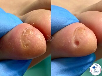 プラスワンフット 本厚木(+1 Foot)/痛い・引っかかる・邪魔な副爪に