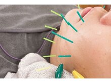 ディア(Deer)/究極小顔リフトアップ美容鍼♪