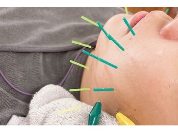 ディア(Deer)/究極小顔リフトアップ美容鍼♪